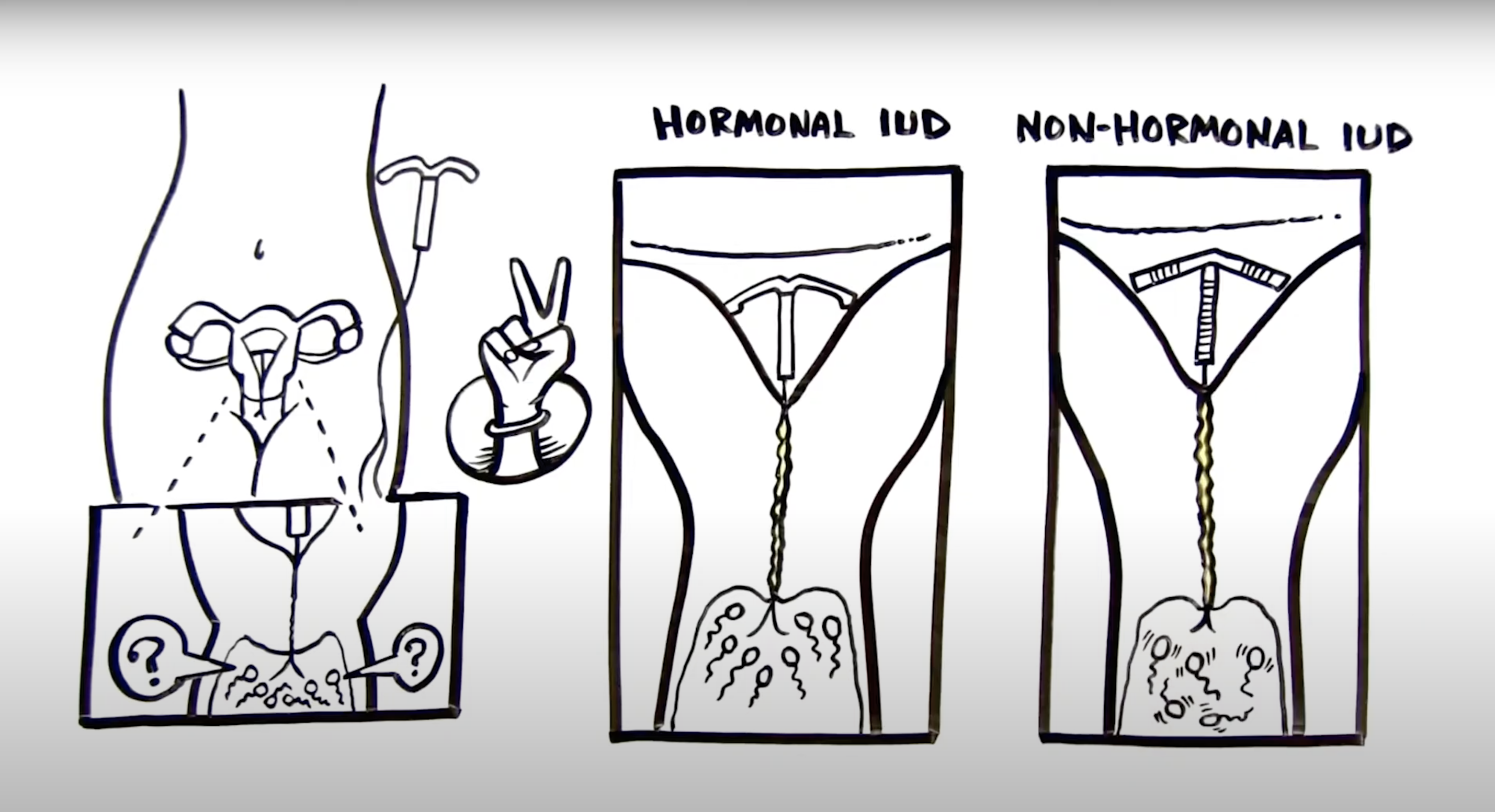 a screenshot of an illustrated video that explains how the IUD method of birth control works