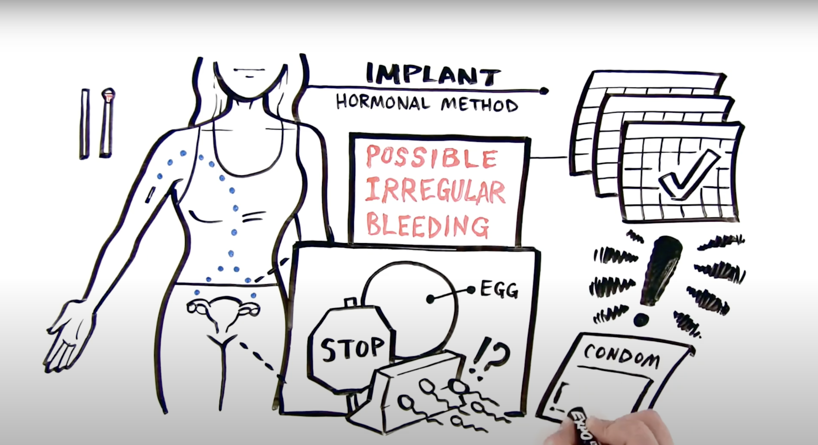 screenshot of an illustrated video that describes how the implant method of birth control works